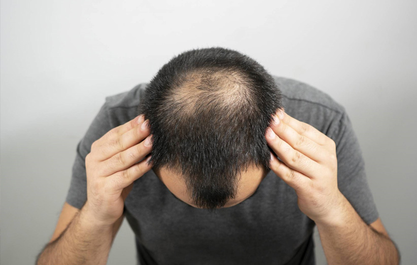روش تضمینی جلوگیری از ریزش مو ا گیاهان دارویی و سیاه دانه
