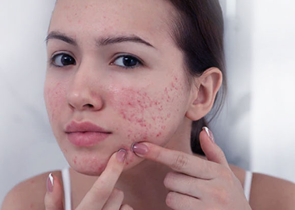 کرم ضد آفتاب پوست حساس، بهترین و م ناسب ترین کرم های ضد آفتاب برای پوست های آسیب دیده