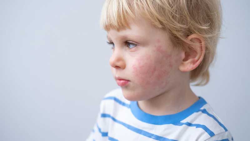 نشانه های اگزمای پوست در کودکان