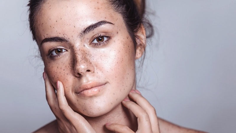 رفع و نابودی لک‌های پوست صورت و بدن با روش های اثربخش